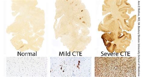 The study is the largest of its kind, and focused on the brains of 202 deceased former football players. CTE: Football's Growing Medical Crisis