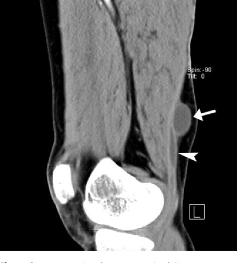 Figure From Intratendinous Ganglion Cyst Of The Semimembranosus Tendon Semantic Scholar