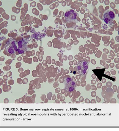Figure 3 From A Case Of Chronic Eosinophilic Leukemia In A Patient With