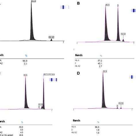Capillary Electrophoresis Pattern Of Hemoglobin Variants Done With