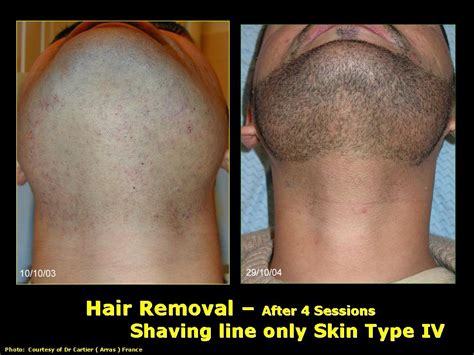 Ipl Hair Removal Before And After