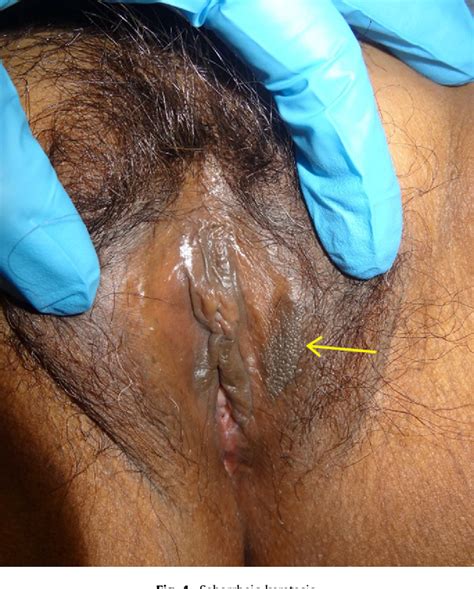 Figure From Benign Lumps And Bumps Of The Vulva A Review