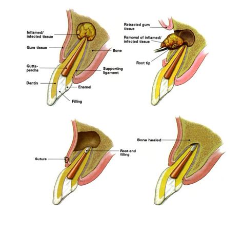 Apicoectomy Procedure Explained News Dentagama