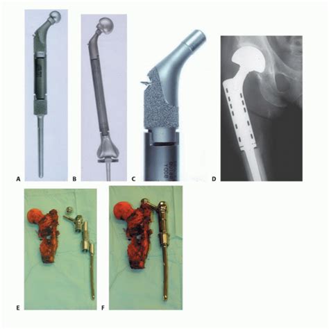Proximal And Total Femur Resection With Endoprosthetic Reconstruction