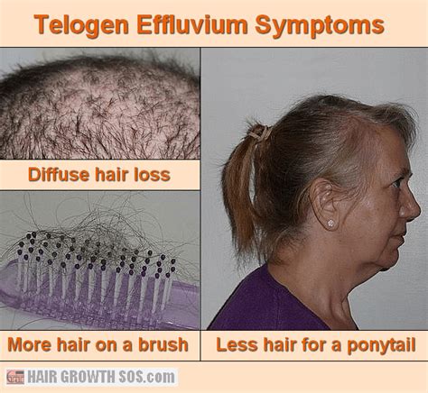 What Is Telogen Effluvium Causes Signs And Treatment Justinboey