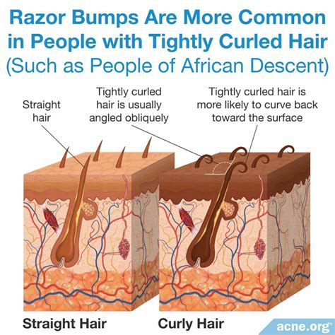 What Are Razor Bumps