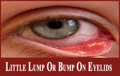 Bumps On Eyeball Causes Types And Treatment Vrogue