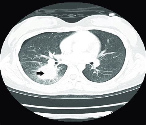 Thoracic Ct Scan Shows A Hypodense Mass Located In The Right Lower Lobe