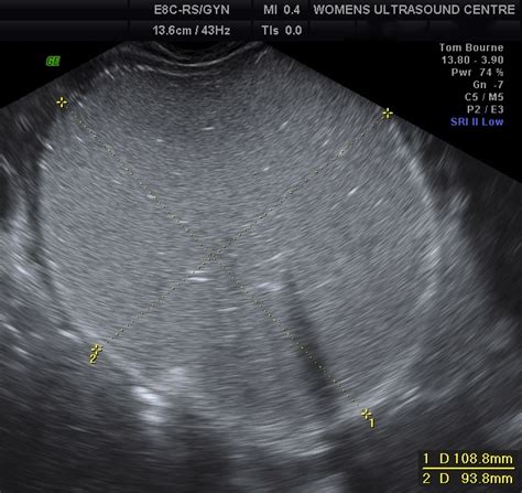 Ovarian Cysts Womens Ultrasound Clinicwomens Ultrasound Clinic