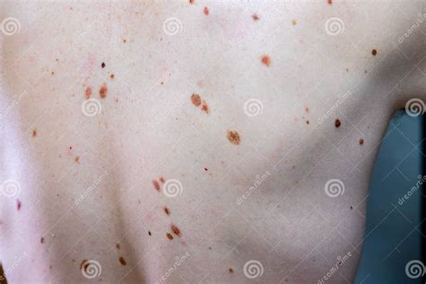 Melanocytic Nevus Some Of Them Dyplastic Or Atypical On A Caucasian