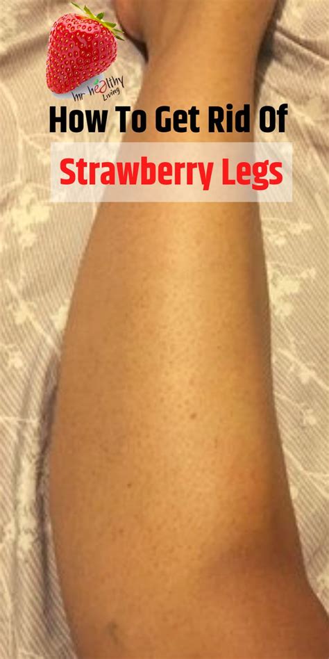 How To Get Rid Of Strawberry Legs Dry Skin Remedies Ingrown Leg Hair