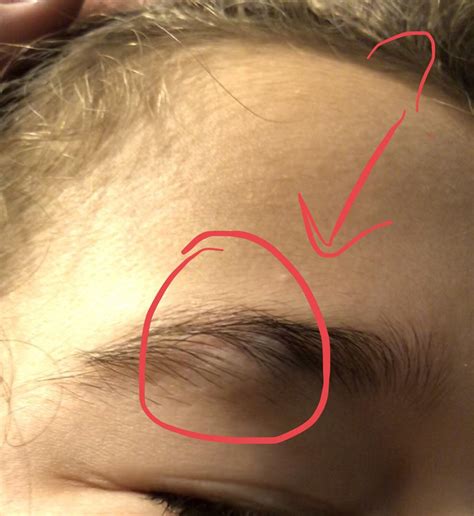 Lump Under Eyebrow Any Idea What It Is Thought It Was A Bruise At