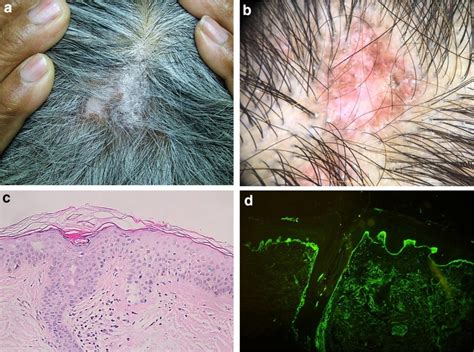 Hair And Scalp Changes In Cutaneous And Systemic Lupus Erythematosus