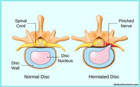If you're struggling with a recurrent herniated disc and want. Spine Surgery in India | Cost Effective Surgery at Top Accredited Hospital