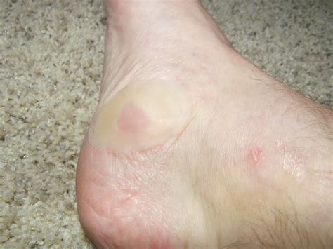 Dealing With The Problem Of Preseason Blisters Soccer Cleats 101
