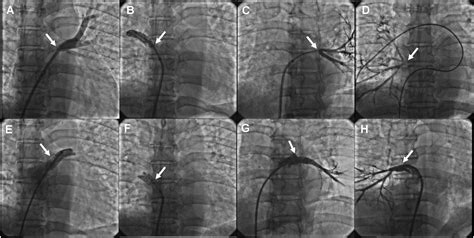 Stent Implantation For Severe Pulmonary Vein Stenosis Or Occlusion