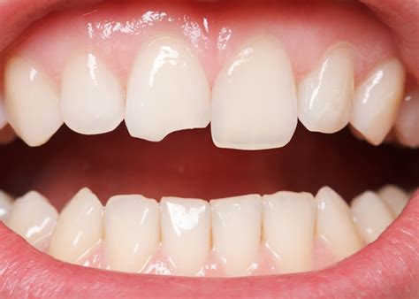 Cracked Tooth Dental Treatments Abroad Dental Clinic Heraklion Crete Uncategorized