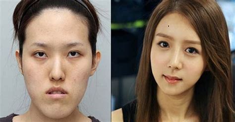 Why Is Plastic Surgery So Popular In South Korea By Cliniccokr Medium