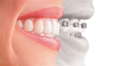 Ortodoncia Vs Implantes Dentales A O Clinica Nudent Trujillo