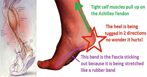 This One Stretch Relieves Plantar Fasciitis Shin Splints Achilles