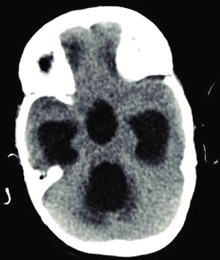 Contrast Enhanced Computed Tomography Brain Showing Dilatation Of All
