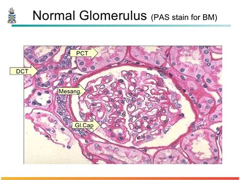 Ppt Pathology Of Glomerulonephritis Powerpoint Presentation Free