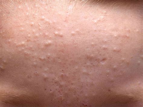 White Bumps On Face Milia And Other Causes