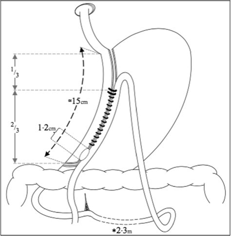 Diagrammatic Representation Of The One Anastomosis Gastric Bypass