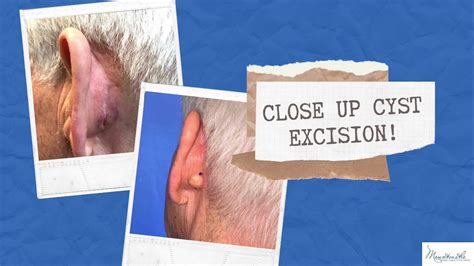 Benign Ear Cyst Or Tumor As Related To Cephalexin Pictures