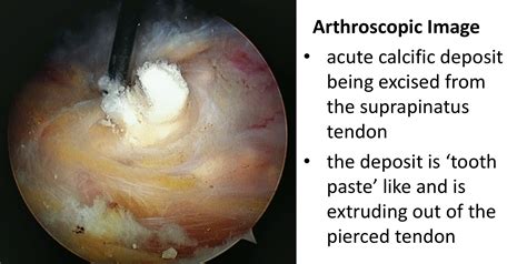 Calcific Tendonitis Cambridge Shoulder