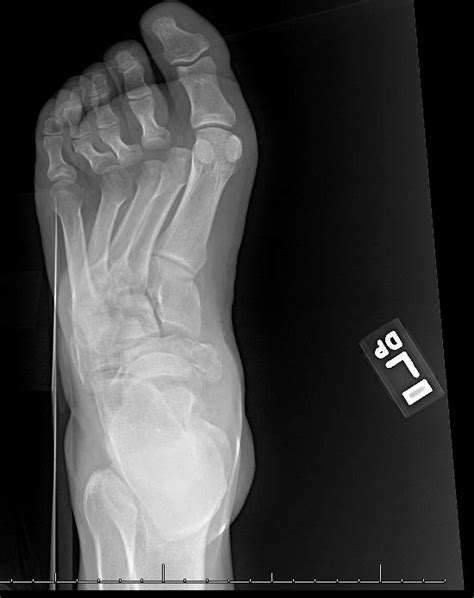 Midfoot Crush Injury The Foot And Ankle Online Journal