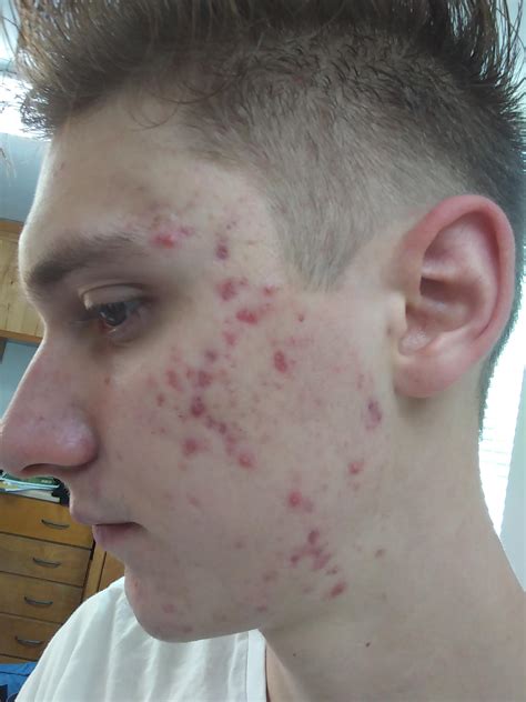 Acne Had A Big Outbreak Of Cystic Acne About A Month Ago Think Ive