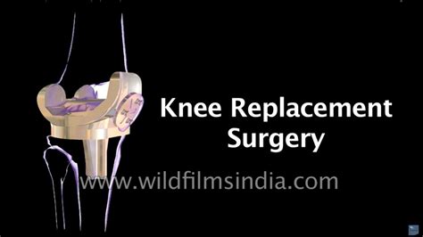 Total Knee Replacement Surgery Magic Of Medicine Youtube