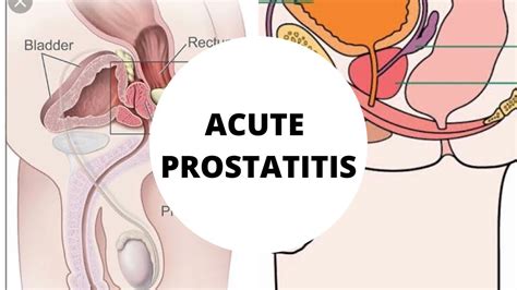 What Is Acute Prostatitis Part 2 Made Simple Etiology Symptoms And Diagnosis Youtube
