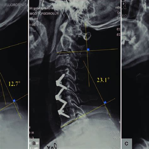 Cervical Lateral Radiographs Of A 62 Year Old Man From Zp Group Showing