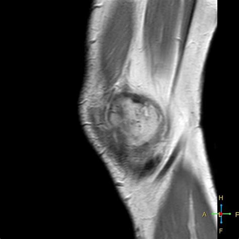 Spontaneous Osteonecrosis Of The Knee Sonk Image
