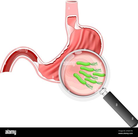 Helicobacter Pylori Bacteria Stomach With Peptic Ulcer Disease And Magnifying Glass Vector