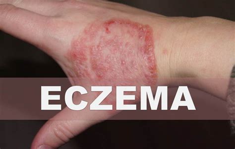 Remedios Caseros Para La Eczema Como Aliviar La Piel Seca Escamosa E