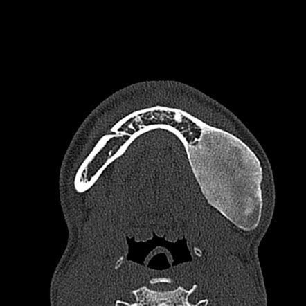 Fibrous Dysplasia Mandible Radiology Case Radiopaedia Org