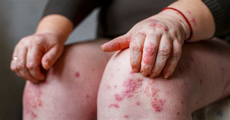 psoriasis rash pictures causes symptoms and treatment