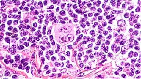 Study Reveals Preferences Of Tumor Cells In Hodgkin Lymphoma
