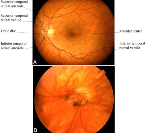 A Normal Fundus And Those Of Premature Infants With Rop A Shows The