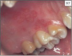 Herpetic Gingivostomatitis Palate