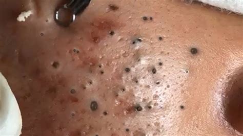 Big Cystic Acne Blackheads Extraction Blackheads And Removal Pimple