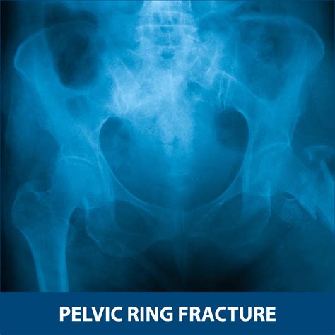 Pelvic Ring Fractures Florida Orthopaedic Institute