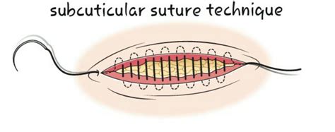 Surgery Basics Suture Techniques There Are Four Frequently