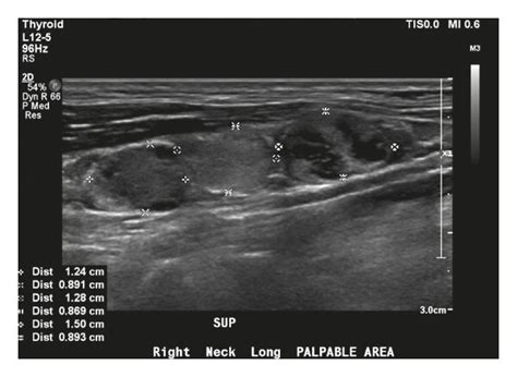 Ultrasound Transverse Image Of Lymphadenopathy In The Right Cervical