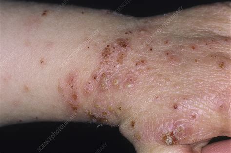 Eczema Herpeticum Stock Image C0531929 Science Photo Library