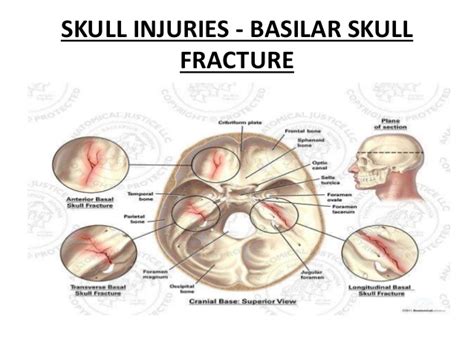 Orthopedics a fracture involving the base of the cranium clinical may be asymptomatic; Skull Fracture, Basilar; Basilar Skull Fracture; Battle Sign
