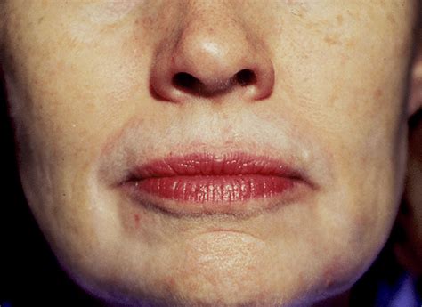 Patient Who Has Perioral Hypopigmentation Download Scientific Diagram